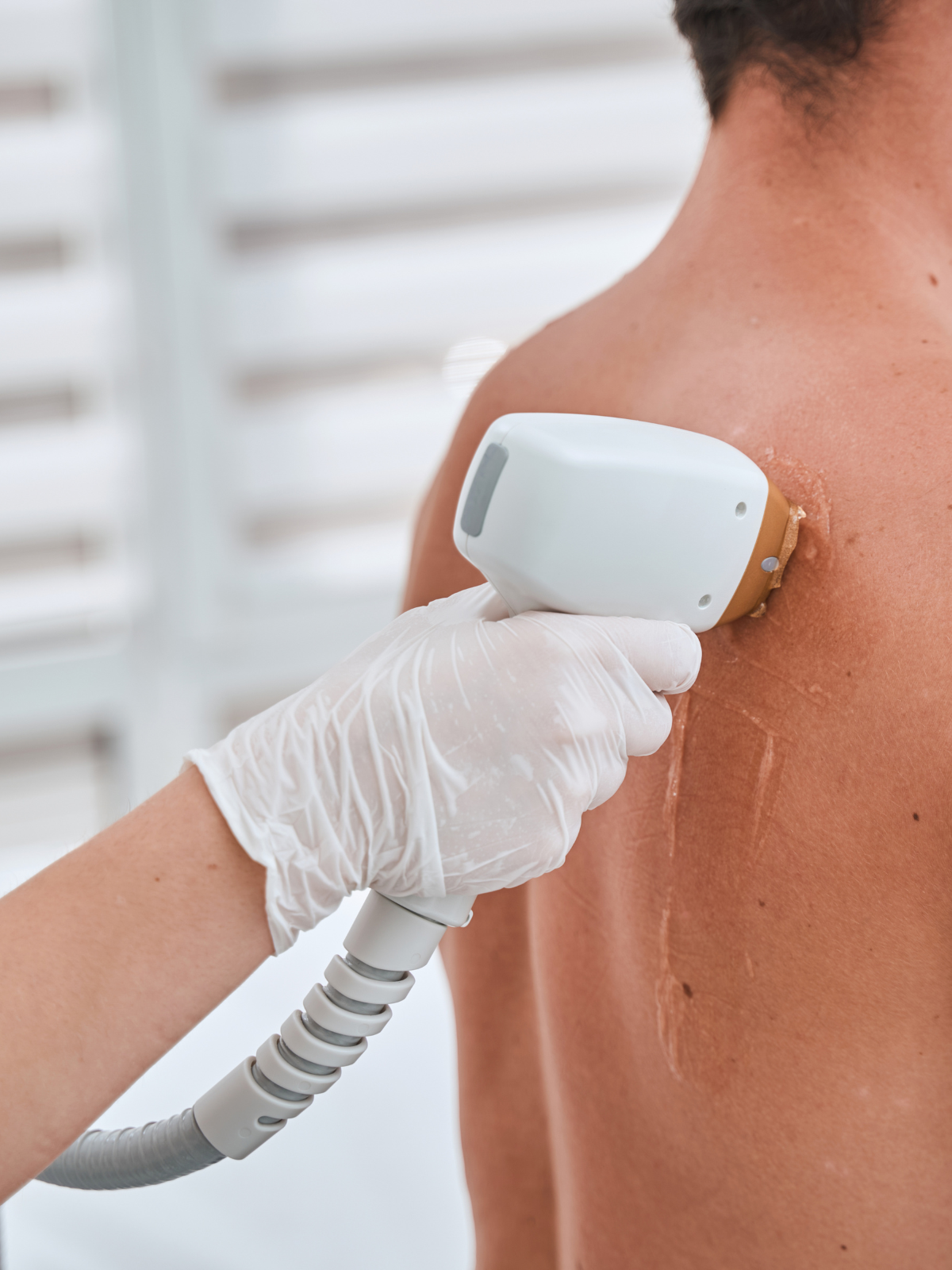 Depilación Láser Masculina