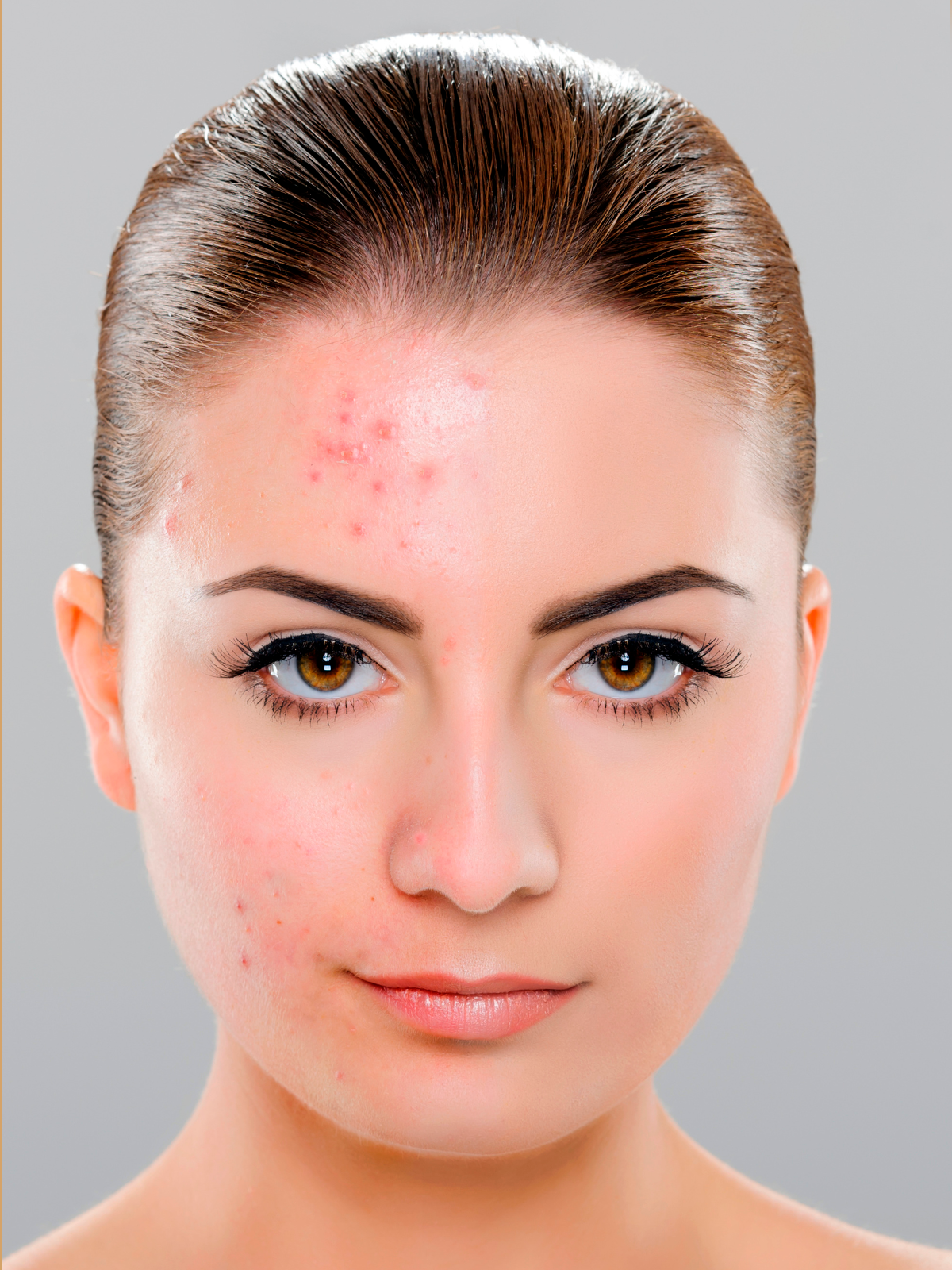 Manchas, marcas acne, cicatrices